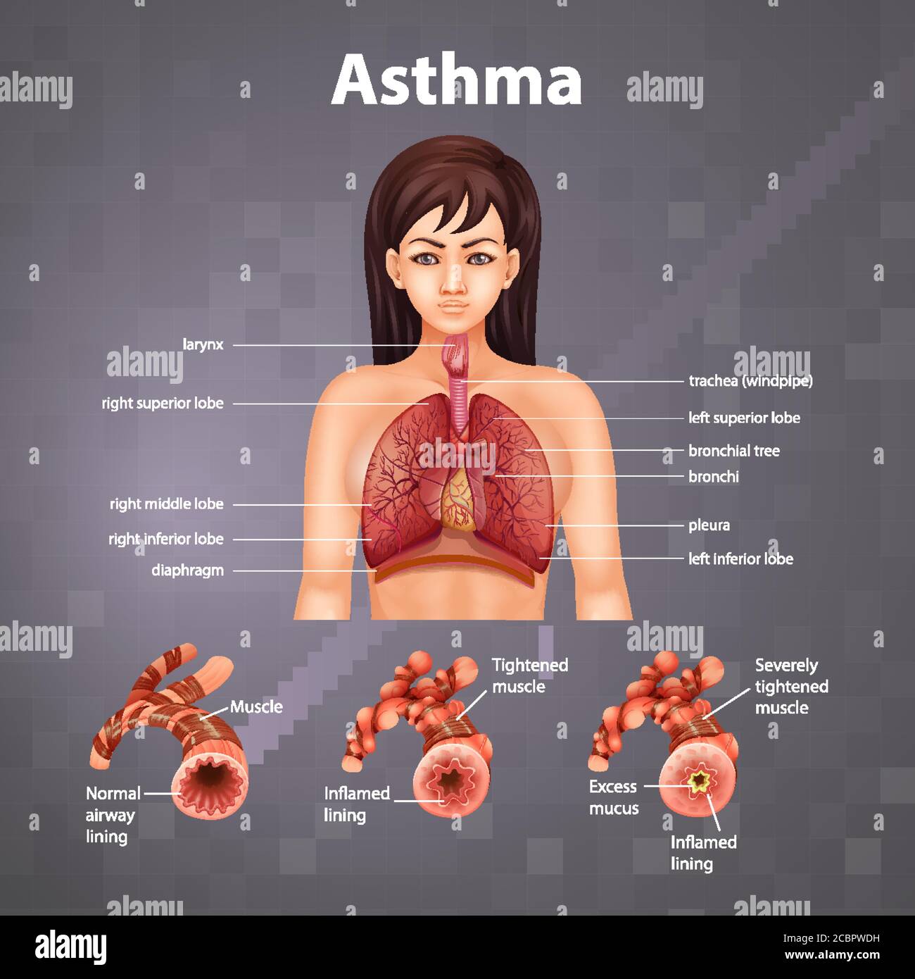 Vergleich von gesunder Lunge und asthmatischer Lunge Abbildung Stock Vektor