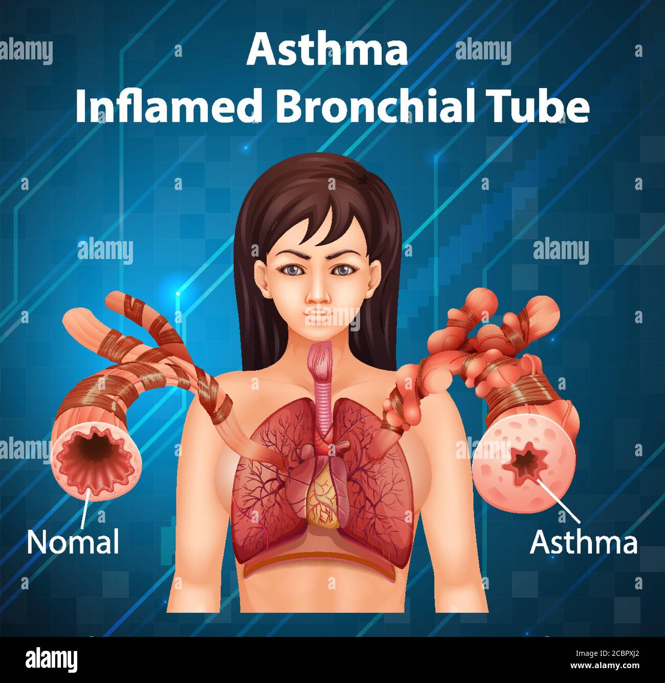 Menschliche Anatomie Asthma entzündete Bronchialröhrchen Abbildung Stock Vektor