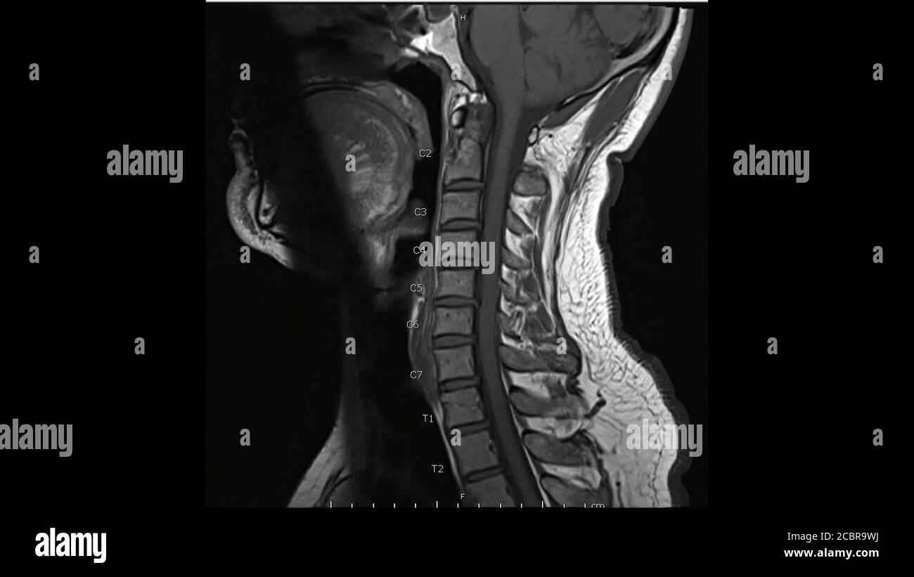 Magnetresonanzbilder der Halswirbelsäule sagittale T1-gewichtete Bilder (MRT-Halswirbelsäule) mit mehreren Bandscheibenerkrankungen, deutlicher bei der C5-6-Bandscheibe. Stockfoto