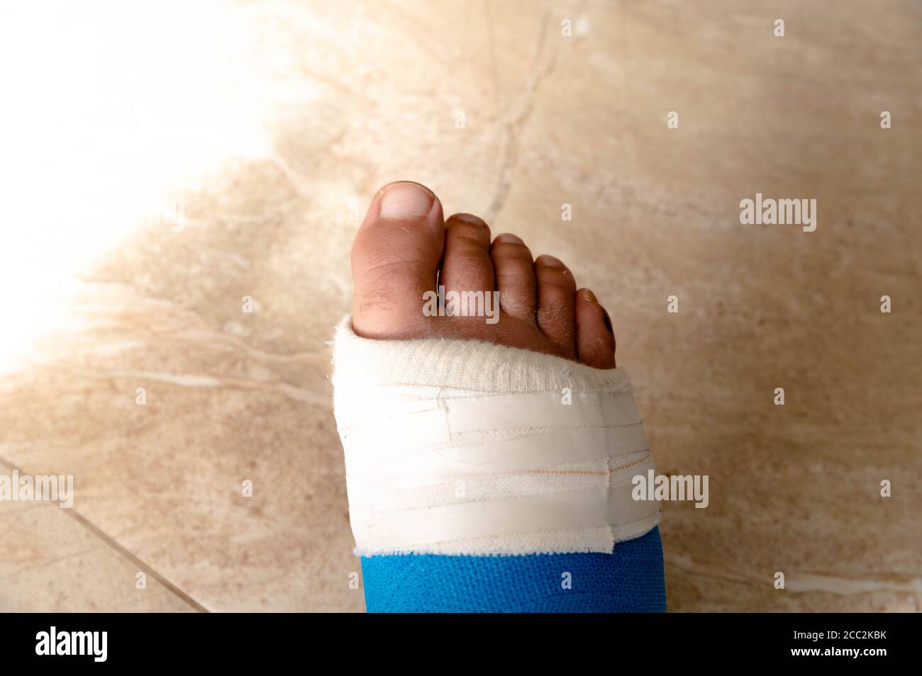 Nahaufnahme der Fußdarm und Zehen, Schwellung um die Zehen aus der Operation Stockfoto