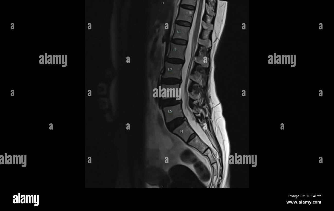 Magnetresonanzbilder der Lendenwirbelsäule sagittale T2-gewichtete Bilder (MRI Lendenwirbelsäule), die eine leichte Bandscheibenerkrankung zeigen. Stockfoto