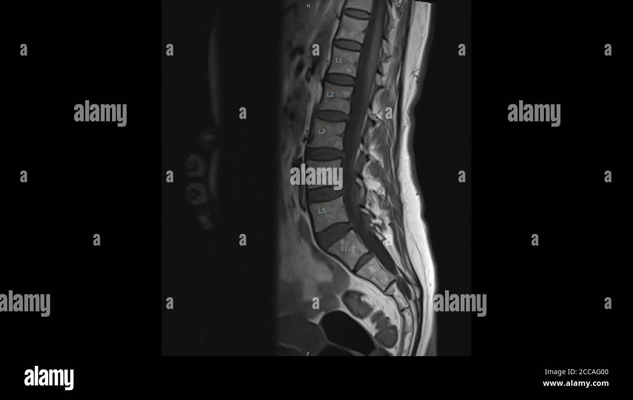 Magnetresonanzbilder der Lendenwirbelsäule sagittale T1-gewichtete Bilder (MRI Lendenwirbelsäule), die eine leichte Bandscheibenerkrankung zeigen. Stockfoto