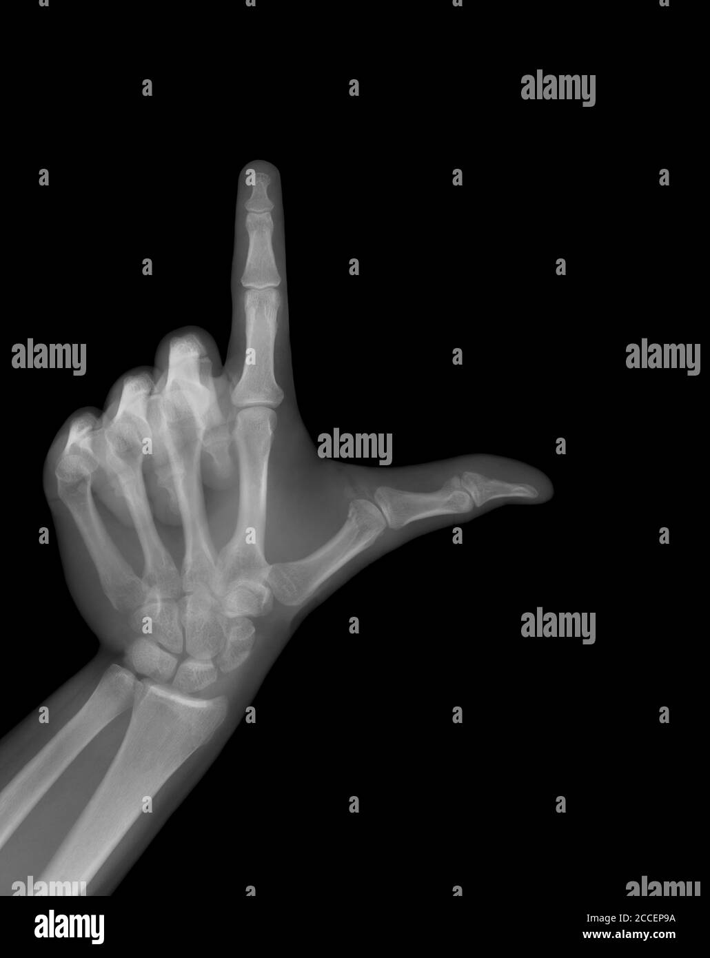 Handzeichen, Röntgen Stockfoto