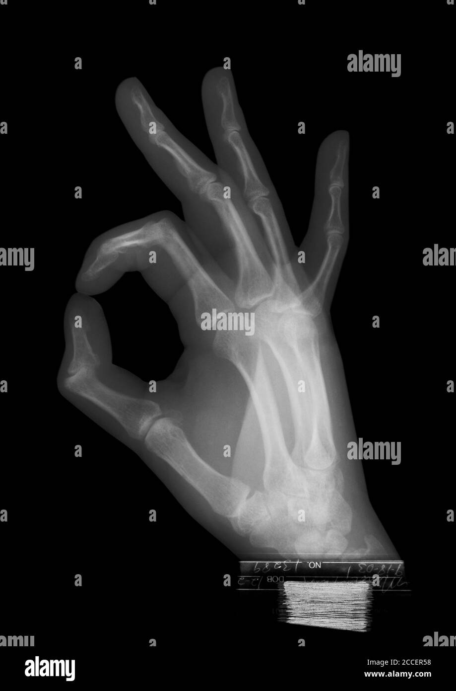 OK Handbewegung, Röntgen Stockfoto