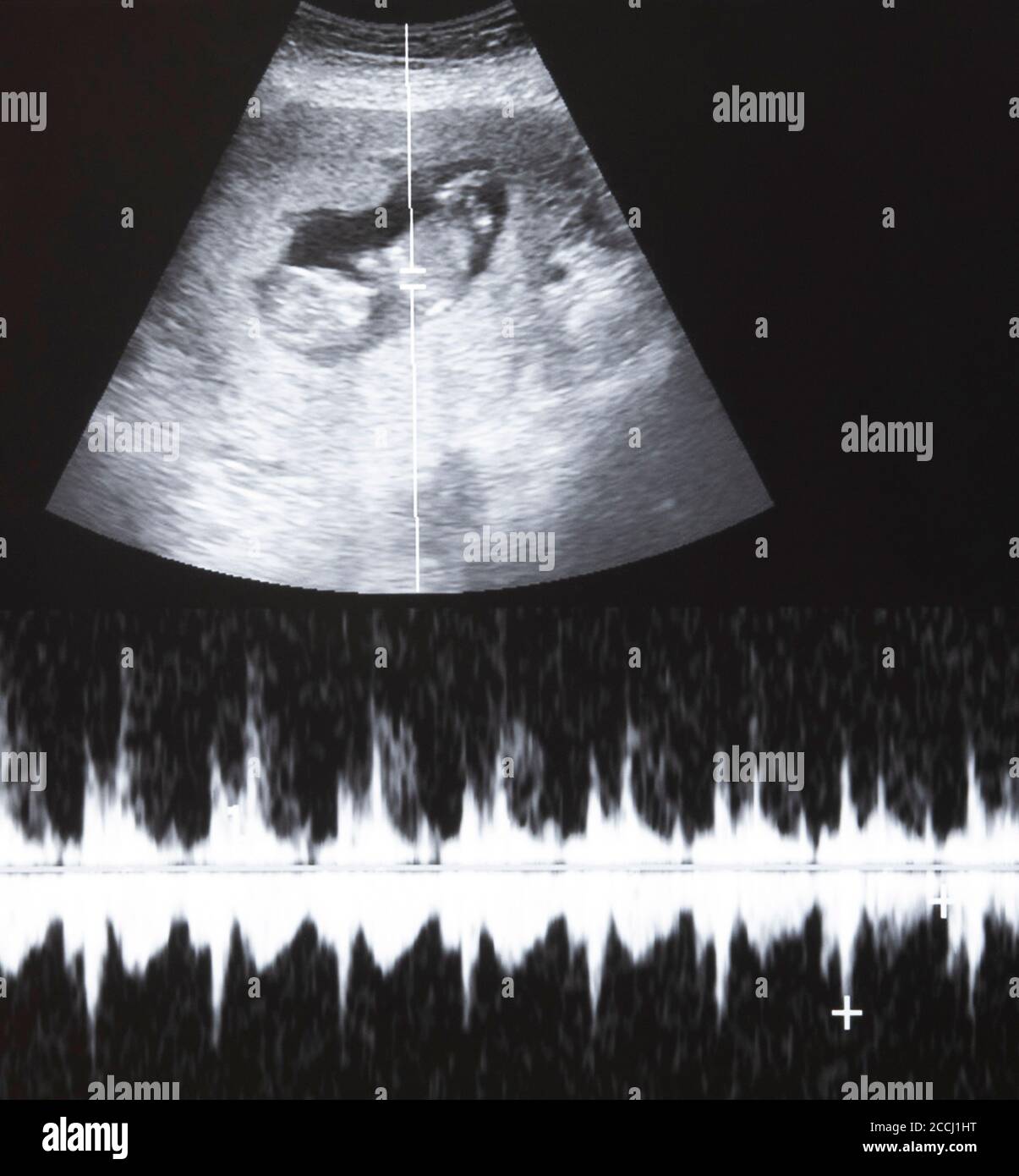 Ultraschall des Fötus mit Herzschlagraph Stockfoto