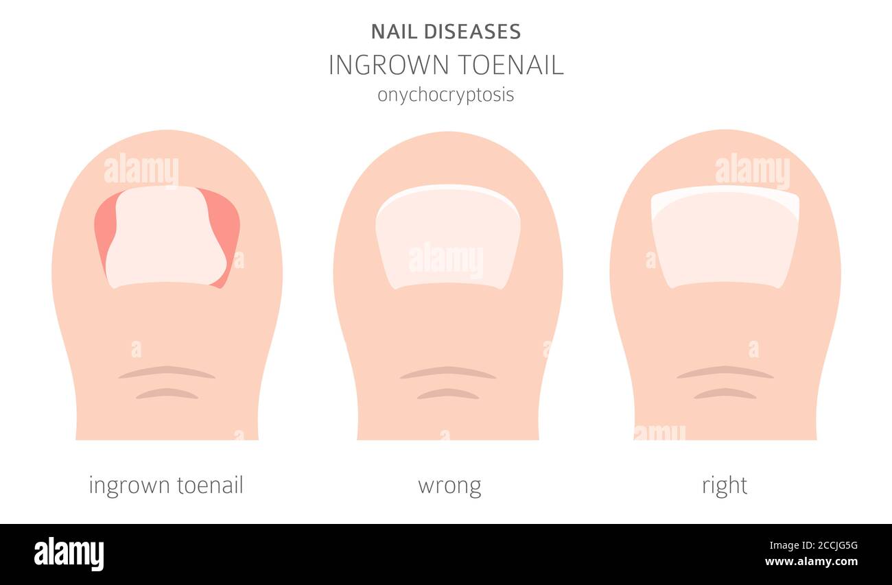 Nagelkrankheiten. Onychocryptosis, eingewachsene Zehennagel. Design medizinischer Infografik. Vektorgrafik Stock Vektor