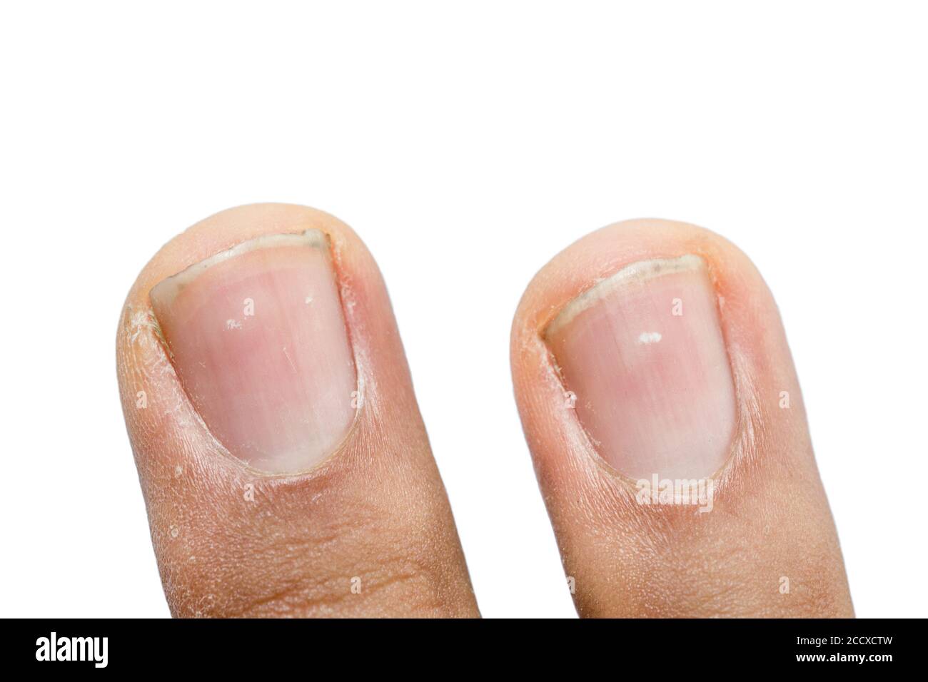 Was Bedeuten Weiße Punkte Auf Den Fingernägeln www.alamy.de