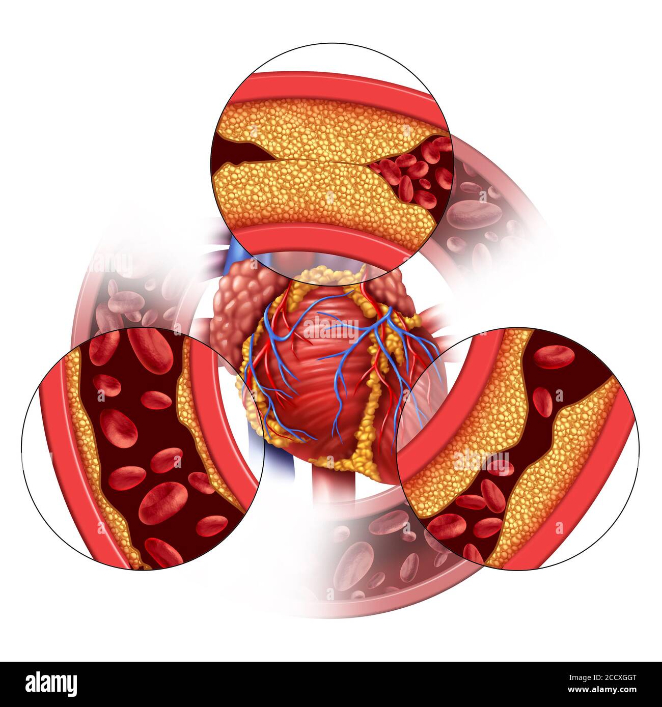 Herzarterienkrankheit und koronare medizinische Konzept als allmähliche Plaquebildung, die zu verstopften Arterien und Atherosklerose als menschliche Anatomie. Stockfoto