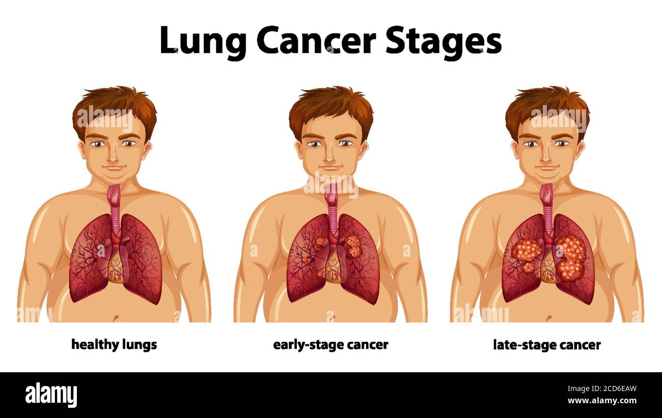Informative Illustration von Lungenkrebsstadien Stock Vektor