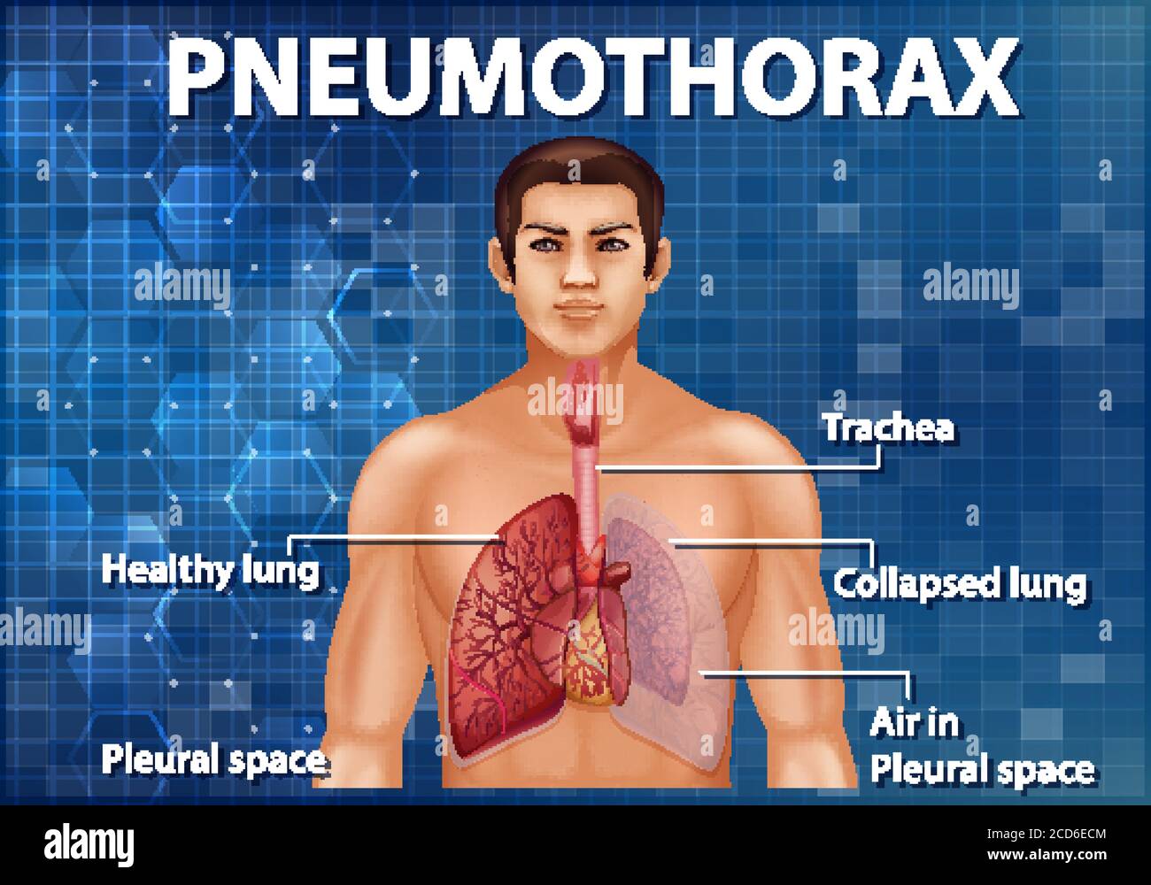 Informative Illustration der Pneumothorax Illustration Stock Vektor