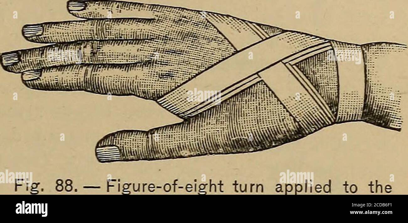 . Erste Hilfe bei Krankheit und Verletzung; . DIE ROLLENBANDAGE I05. 1. - Acht-Figur-Drehung auf die Hand angewendet. Die Spikawende (Abb. das Ende der Bandage an der Palmargeseite des Handgelenks; (2) über den Handrücken und unter den Daumen bringen, und (3) über die Handfläche an der Wurzel der Finger; dann (4) nach oben und über den Rücken zu thewrist; (5) über das pal-mar-Gesicht des Handgelenks; dann (6) nach oben und acrossthe zurück, über die erste Umdrehung; (7) Wiederholung der emaneuvers so manytimes wie es kann entsired werden, um das Band-age über die Hand zu falten, und (8) schließlich Sicherung mit einer kreisförmigen Umdrehung über das Handgelenk Stockfoto