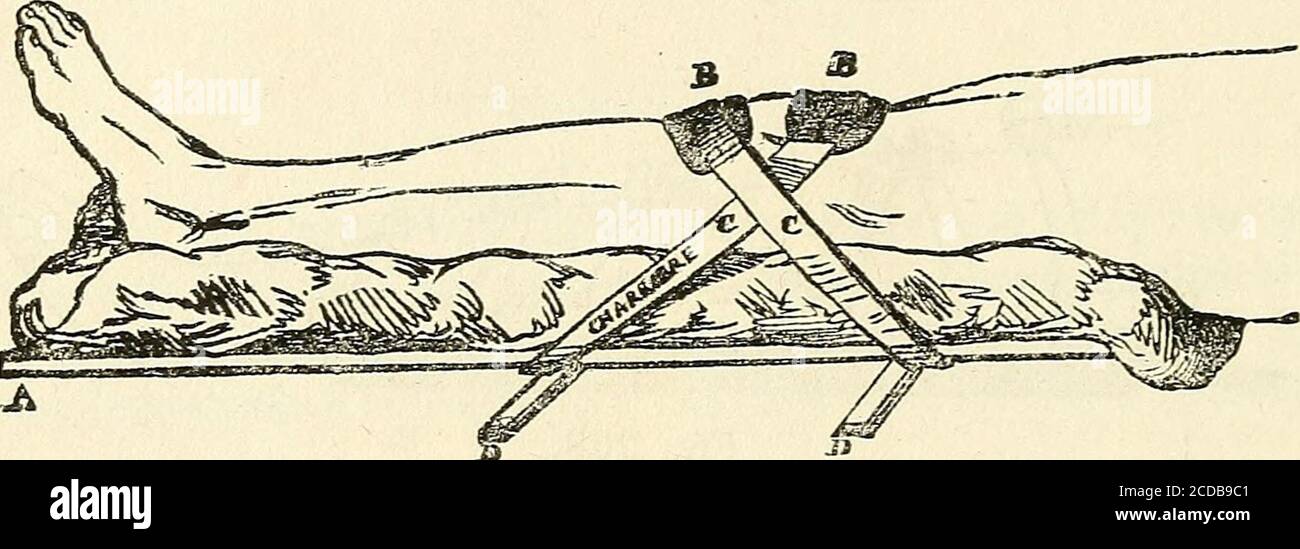 . Manuel de petite Chirurgie . ux liens decaoutchouc ; cest-à-dire quelle est en rapport avec la directionque lon veut donner aux Fragments. Pour appliquer lappareil, on fait soulever le membre et longlisse sous lui la planche garnie de son coussin : on doit faire ensorte que la rotule correspondde à peu près au Milieu de lespacequi sépare les deux tasseaux, à moins dindications particulières. Les deux plaques de gutta-percha, modelées sur chacun des 320 APPAREILS DE FRAKTUREN. Fragments quelles embrassent en haut et en Bas, sont mainte-nues par les deux liens de caoutchouc qui embrassent à Leu Stockfoto