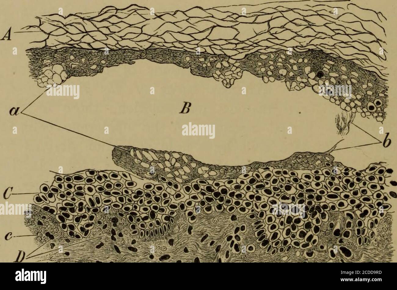 . Die Elemente der pathologischen Histologie mit besonderem Bezug auf praktische Methoden . Fro. 196. – Variola in der Phase des Trocknens. X 95. (Alaun cochineal.) «, Kruste orseal); 6, verengte rete Malpighii; c, Cutis infiltriert mit runden und Spindel colls.. Abb. 197. – kutane Verbrennung des zweiten Grades, x 240. (Haeinatoxjdin andeosin.) A, Stratum corneum; B, Bildung von Bläschen in den oberen Schichten der reteMalpighii; C, unter Schicht von rete Malpighii; 2), Papilla} von Cutis ; A, nekrotische Zellen ofrete Malpighii; h. Längliche nekrotische Zellen; c, Extravasatcd rote Teilchen. PEMPHIGUS UND VARIOLA 38 Stockfoto