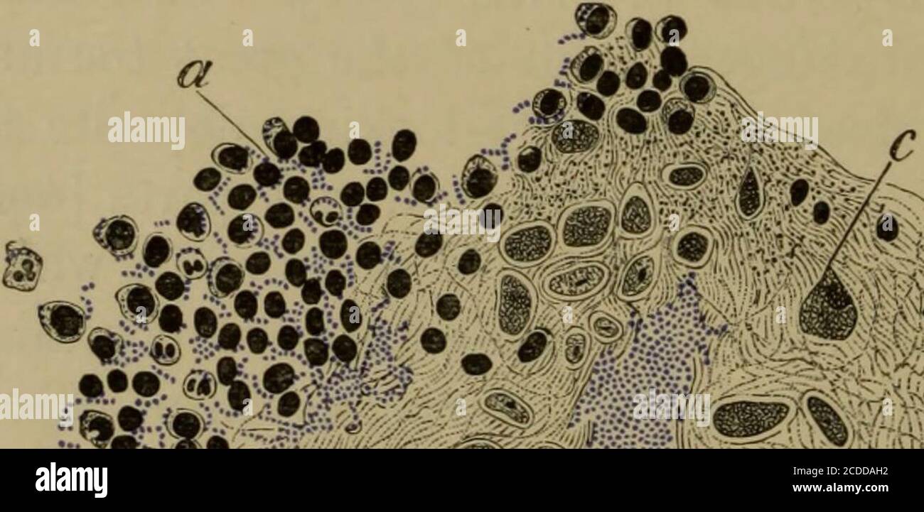 Eitrige arthritis Fotos und Bildmaterial in hoher Auflösung Alamy