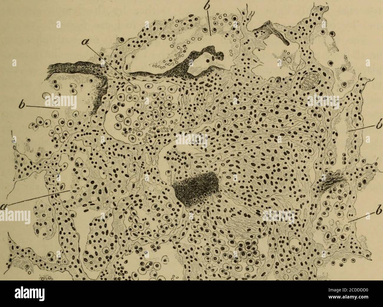 . Die Elemente der pathologischen Histologie mit besonderem Bezug auf praktische Methoden . ual alveoli {a) können oft noch unterschieden werden. Die Blutgefäße innerhalb des Areas dieser Flecken werden dann abgeschafft, sei es durch Kompression oder durch Verschließen aufgrund des Wachstums ihrer Zellen; während Kasétion in den Mittelpunkt des Fokus setzt. Sind die Tuberkelbazillen durch den Kreislauf in die Lunge gebracht worden, bilden sich in der Regel in allen Teilen des Organs sehr schnell zahlreiche Tuberkel, während nach der Einbringung der Bazillen durch die Inspirationsluft oder die Lymphgefäße an der Tanne nur isolierte Tuberkel wachsen Stockfoto