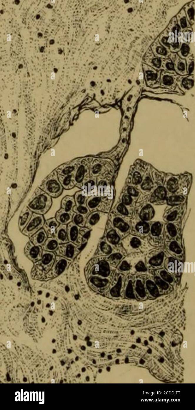 . Die Elemente der pathologischen Histologie mit besonderem Bezug auf praktische Methoden . •;;;--:;^^.;^^^•:-:;^ vl^^V- ?^i»^. Grippe. 51. – SciRRHUs MAMM.*:. X 2-10. (Hajmatoxylin und Eosin.) A, kleine krebsartige Alveolen; b, Emptj krebsartige Alveolen; c, stark entwickeltes Bindegewebsstroma, teilweise durchdrungen von runden Zellen. KOLLOIDKARZINOM 107 wird konfluent, bis schließlich der gesamte Alveolus mit atransparenter gelatinöser Substanz gefüllt wird, in der nichts mehr zu sein ist Stockfoto