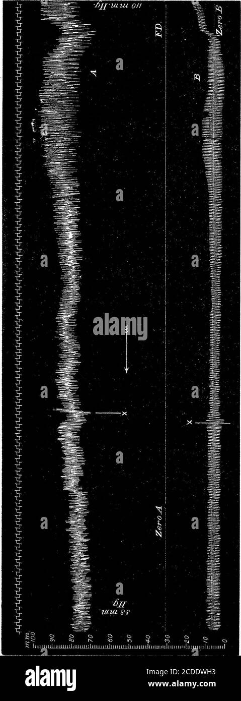 . Bei zerebraler Anämie und den Folgen der Ligation der zerebralen Arterien folgt diese Lähmung sofort aufkrampfenden Bewegungen, tritt aber 10 Minuten lang nicht auf, wenn die Hunde ruhig bleiben.der postepileptische Verlust der kortikalen Erregbarkeit ist ein weiteres und bekanntes Beispiel für die lähmende Wirkung von krampfhaften Entladungen. Der Lidreflex, abhängig vom fünften und siebten Nervenkern, besteht nach der Entfernung des Großhirns. Meine Experimente zeigen, dass der Lidreflex verschwindet, aber kurze Zeit vor dem Ausfall des Atemzentrums vergeht, während der Pupillenreflex konside verloren geht Stockfoto