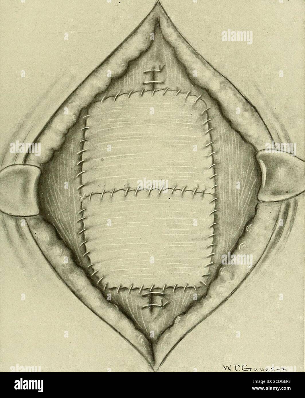 . Gynäkologie : . Abb. 445. - Transplantation der Fascia Lata für postoperative Hernie (Bartletts-Methode). Zeigt die Methode der Fasziensektion vom Oberschenkel. In Form eines Parallelogramms und in warme normale Salzlösung untilneeded. Die Wunde des Beins ist geschlossen. Die Bauchwunde wird dann aufgedeckt. Ohne irgendeinen Inzisionin der Faszie zu bilden, wird der herniale Vorsprung invertiert und die Kanten des gedrehten-inportion mit catdarm vernäht, Obacht ausgeübt, nicht die Faszie sodeeply zu durchbohren, um eine Schleife des Darms zu verletzen, der nahe unten adhärent sein kann. OPERATIONEN AN DER BAUCHWAND Stockfoto