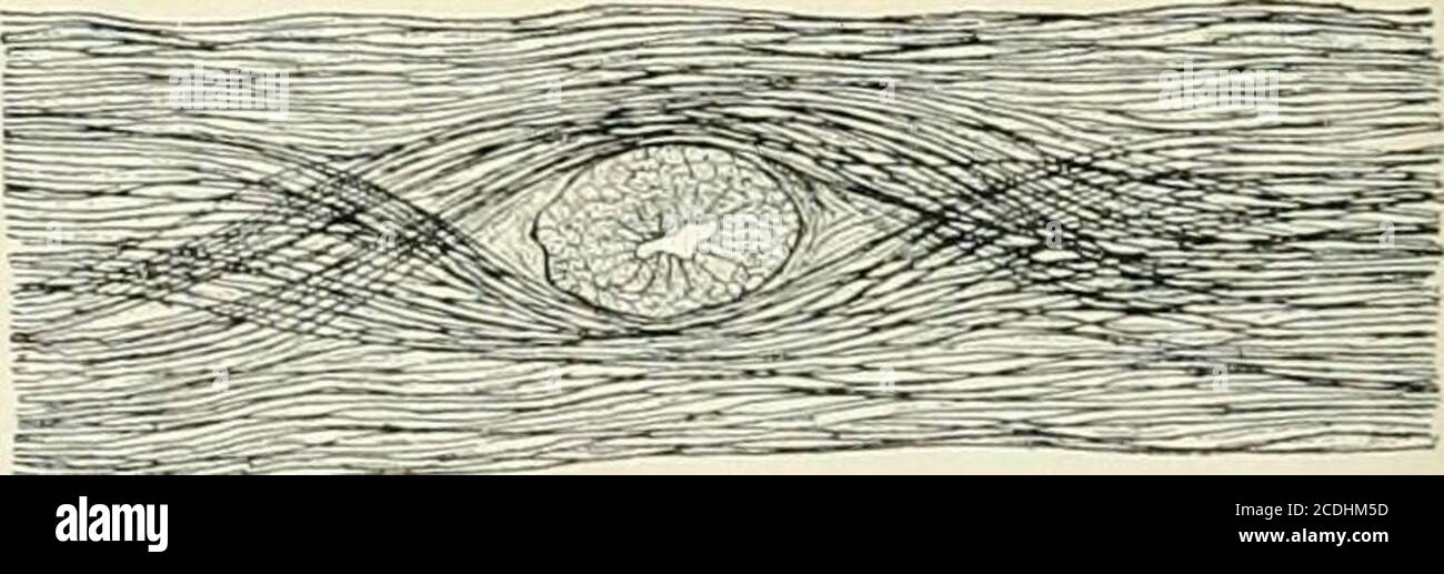 . Ein Referenzhandbuch der medizinischen Wissenschaften, das das gesamte Spektrum der wissenschaftlichen und praktischen Medizin und verwandten Wissenschaft umfasst. Rting Aeby inthis lespect, aber stark widersetzt ihn in der Art und Weise, in der die Bronchien aus Tlie maiu Stamm entstehen. Die Lungensind zunächst symmetrisch und haben auf jeder Seite einen epar-terialen Bronchus. Abweichungen von dieser Art sind auf das Ergebnis der Atrophie zu verstellen. Der eparterielle Bronchus ist kein später.al Ast eines hyparteriellen Bronchus, wie er von Narath abgeschrieben wurde, sondern ein sjieeialer Bronchus. Bireh-HirschfeUl ? Hat den Bronchialbaum der Erwachsenen untersucht und stimmt zu Stockfoto