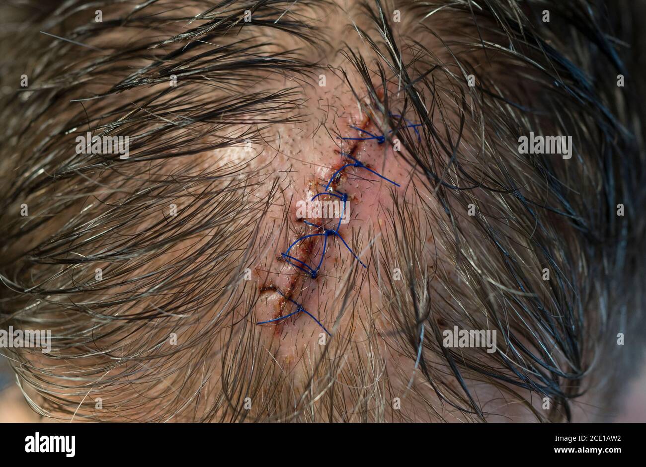 Eine genähte Wunde auf dem Kopf des Mannes. Nahaufnahme. Stockfoto