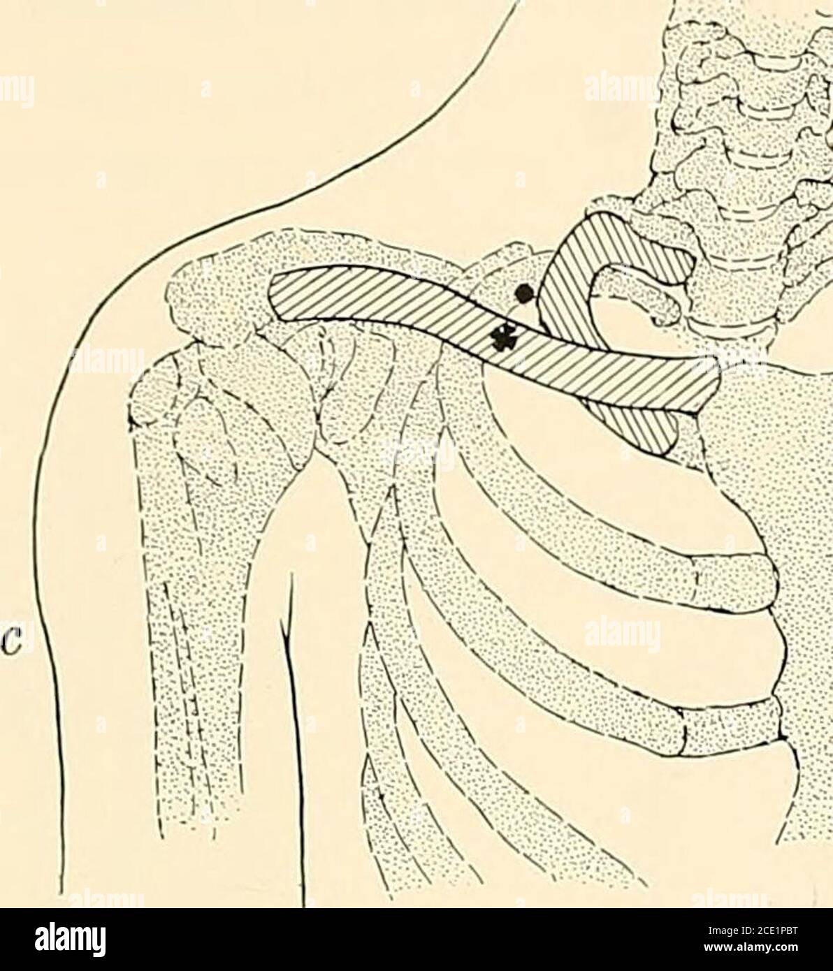 . Regionalanästhesie : seine technische und klinische Anwendung . Abb. 161.- Brachialplexus-Block durch die supraklavikuläre Route bezogen auf das Keleton: Ein vollständiges Bild der anatomischen Merkmale, die der Anästhesist visuell-tizes, während direkt in die supraklavikuläre Region, auf etwa der Höhe des Mittelpunktes des Schlüsselbeins; b, der Anästhesist vergisst kurzzeitig die Existenz des Plexus und kümmert sich um die Arterie. Nach dem Zurückziehen der Arterie wird die Nadel nahe an der Spitze des Zeigefingers eingeführt, der die Schläge des arter- spürt, und vorwärts rückwärts, abwärts und nach innen Towa vorwärtsgerückt Stockfoto