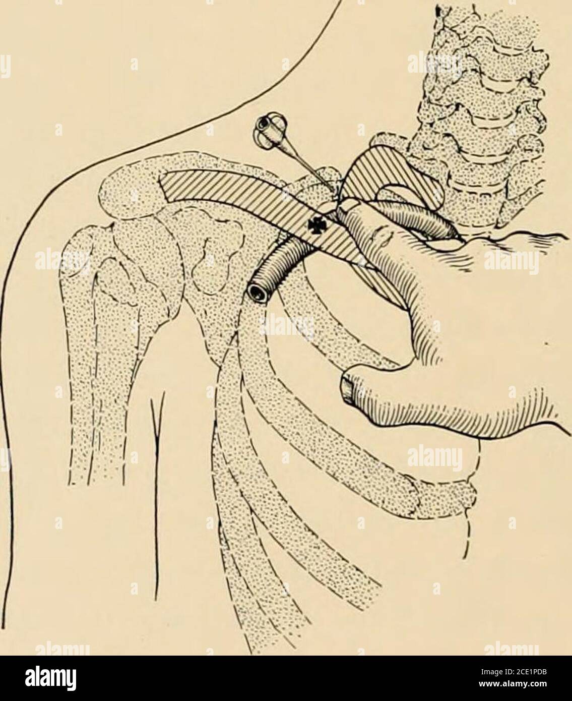 . Regionalanästhesie : seine technische und klinische Anwendung . Abb. 161.- Brachialplexus-Block durch die supraklavikuläre Route bezogen auf das Keleton: Ein vollständiges Bild der anatomischen Merkmale, die der Anästhesist visuell-tizes, während direkt in die supraklavikuläre Region, auf etwa der Höhe des Mittelpunktes des Schlüsselbeins; b, der Anästhesist vergisst kurzzeitig die Existenz des Plexus und kümmert sich um die Arterie. Nach dem Zurückziehen der Arterie wird die Nadel nahe an der Spitze des Zeigefingers eingeführt, der die Schläge des arter- spürt, und vorwärts rückwärts, abwärts und nach innen Towa vorwärtsgerückt Stockfoto