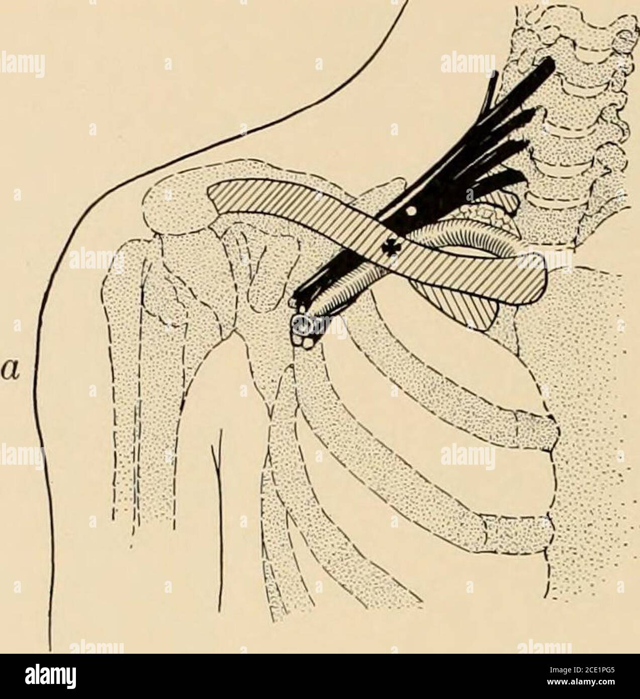 Plexus brachialis obere extremität Fotos und Bildmaterial in hoher