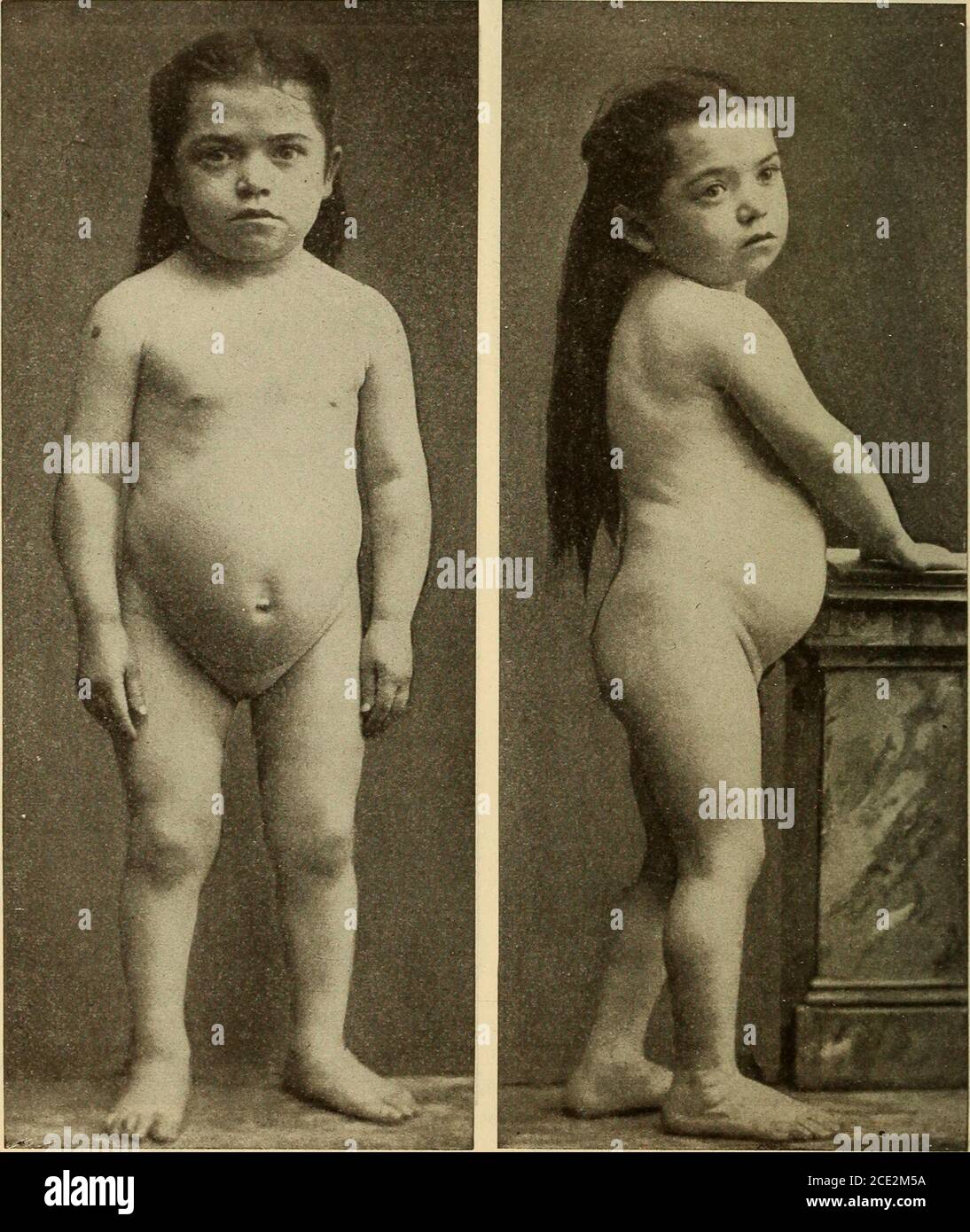. Krankheiten der Kindheit und Kindheit . Abb. 244. – Kretinismus. Gleicher Fall. .ge 9 Jahre.Höhe 37% Zoll, Gewinn 4^ Zoll. Vorderansicht. Abb. 245. – Kretinismus. Gleicher Fall. Vor 0 Jahre;Höhe 87 % Zoll, Verstärkung 4^^ Zoll. Rückansicht. Sie Schnitt ihre Schneidezähne bei ,i/ca)<t Affen und den Rest bei 4 Jahr^. Sie hatte nie Krämpfe oder eine andere Krankheit außer Masern Avhon 4 y«ir-^ von a<ro.Sie begann mit Hilfe auf ihren Füßen zu stehen, als ^ Jahre alt. Sie redete kein Wort, bis 5 Jahre alt, von der Zeit bis 1 übernahm hor sie sagen konnte nicht mehr als Papa und Mannna. Als sie hereinkam Stockfoto