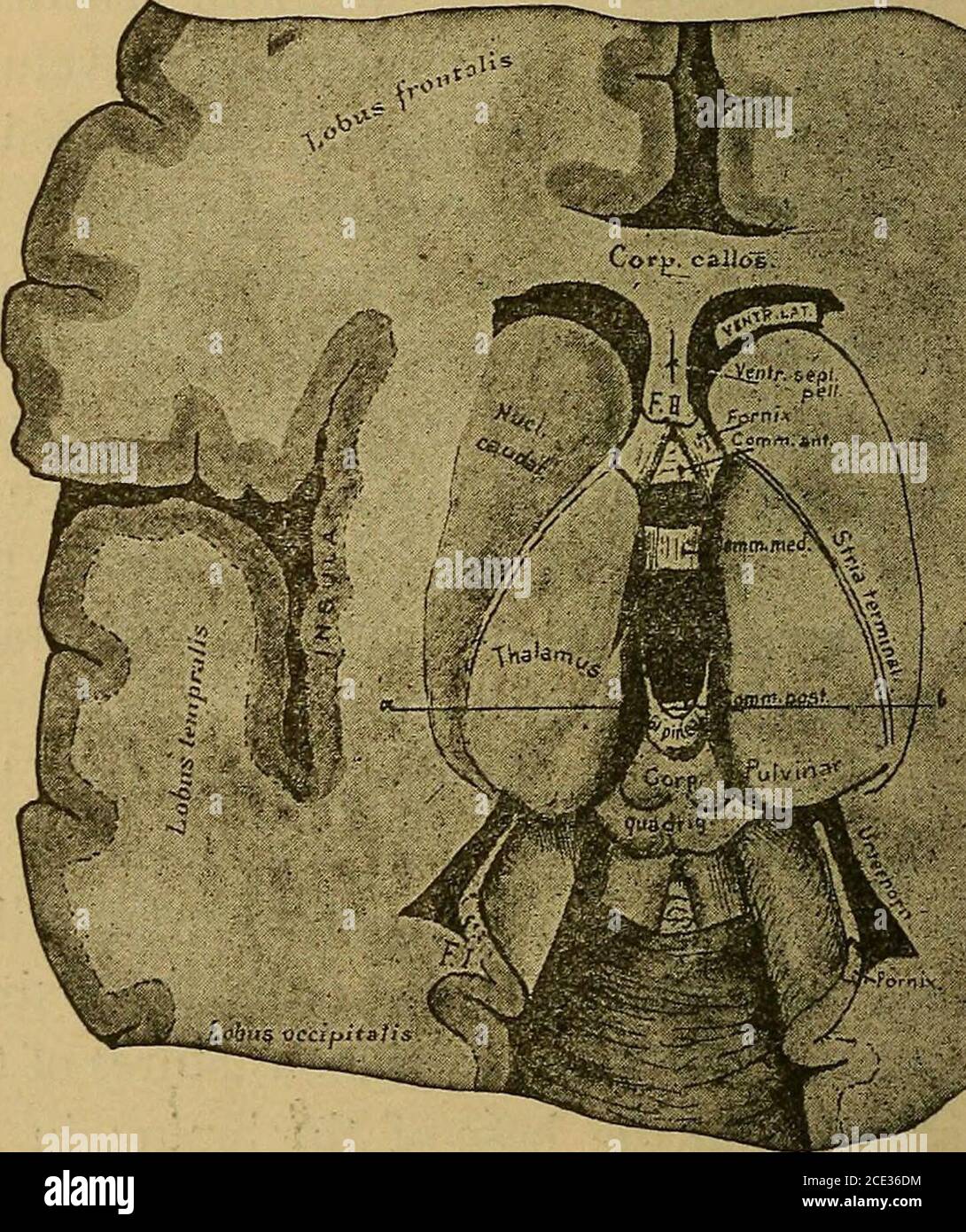 . Eine Abhandlung über die praktische Anatomie: Für Studenten der Anatomie und Chirurgie . Interpositum ; seitlich, durch die inneren Oberflächen der optischen Thalami und die Pedunkles der Zirbeldrüse; der Boden, durch die Strukturen des interpeduncular Raum an der Basis des Gehirns; Vorne, durch die anterioren Säulen des Fornix; hinten, durch den anterioraspekt der corpora quadrigemina und dem Aquädukt von Sylvius. Der dritte Ventrikel ist von grauer Substanz ausgekleidet und wird von drei Kommerzpunkten durchkreuzt: Der vordere, weiße, vor den vorderen Säulen der for-nix platzierte, verläuft zwischen der Korpora striata; der mittlere Stockfoto