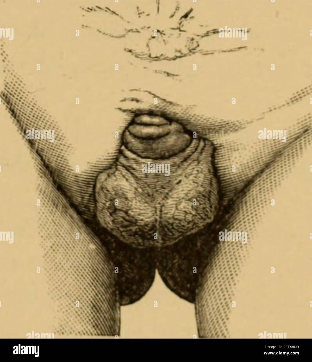 . Ein System der Geburtshilfe . Bigelou a &lt; Operation. Ergebnis ist, die Hautoberfläche des mittleren Hup präsentiert sich auf die Blase, und die rohe Oberfläche wird von der rohen Oberfläche der Seitenlappen bedeckt; die neue Wunde ist links zu cicatrize. Oder sezieren Sie die Schleimhaut der exponierten Blase ab; machen Sie Seitenlappen Prom beide Leistenbereiche (Abb. L91, 192); vereinigen sie nach der Medianlinie und transverselyoverit; die Punkte A, a. a ami b, B zusammen gebracht, wie theskin leichter ergibt in einer Richtung schräg nach oben; das Resultlis perfekt (Feige. L 92). 1 Richards; I». A.yres; J. Wood. J Holz. Stockfoto