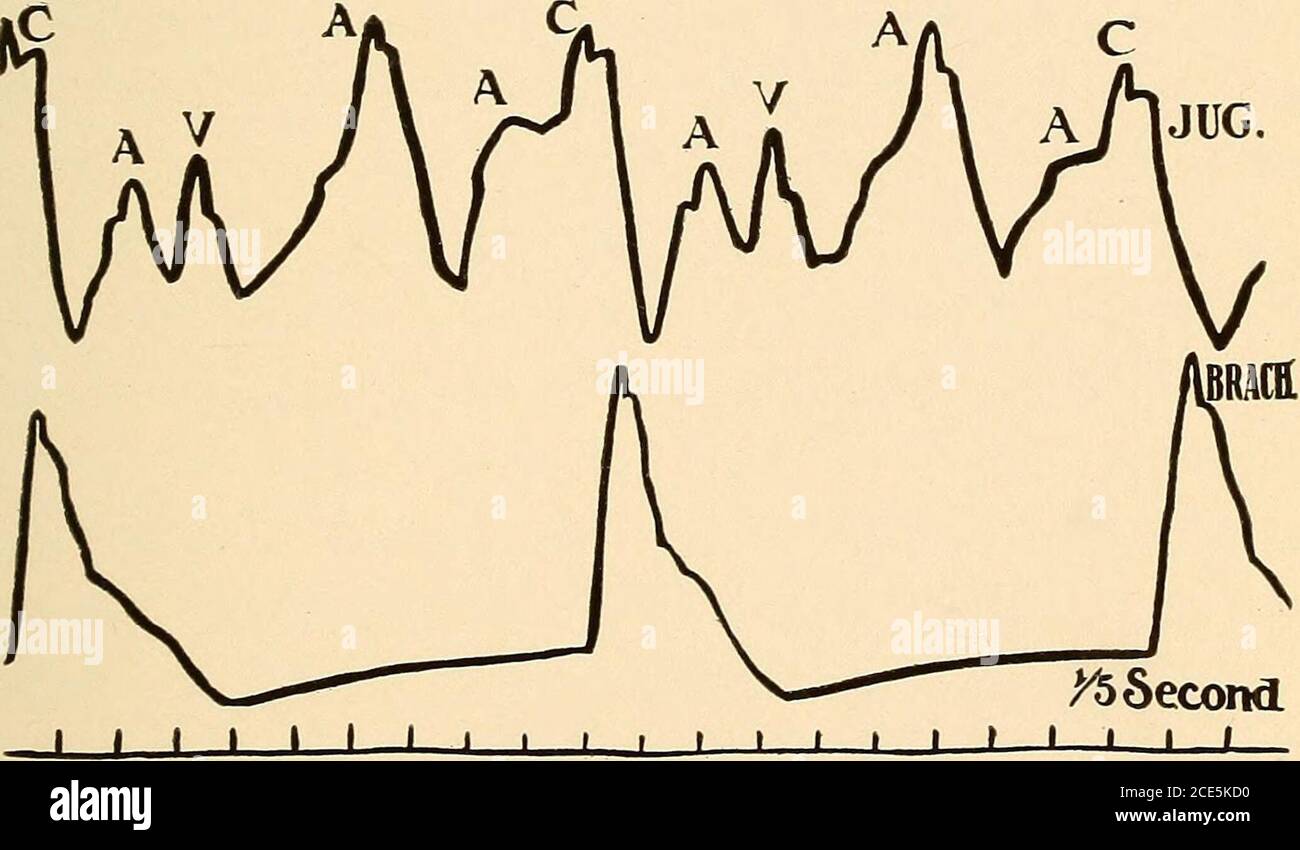 . Geriatrie; die Krankheiten des Alters und ihre Behandlung, einschließlich physiologischer Alter, häusliche und institutionelle Pflege, und medico-rechtliche Beziehungen . Jugular mm /wwwvy^ Brachial /5 second« * » 1 &gt; i i i i &gt; ^ ^ i , i , i – i – alternierende Arrhythmie. (Tasker Howard, M. D., New York MedicalJournal, 3. Mai 1913.) Übertragung Von Arrhythmie. Partieller Herzblock. (TakerHoward, M. D., New York Medical Journal, 3. Mai 1913.) I ARRHYTHMIE 173 Ventrikel oder es kann vollständige Dissoziation zwischen Aurikel und Ventrikel, letztere nach einem eigenen Rhythmus. Dieser wird als kompletter Herzblock bezeichnet. Der Stockfoto