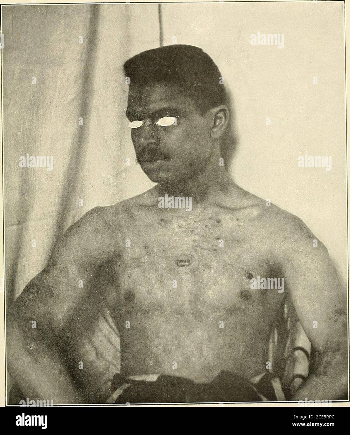 . Amerikanische Praxis der Chirurgie; ein komplettes System der Wissenschaft und der Kunst der Chirurgie. Nary, während hypertrophe Narbe allmählich blasser wird, flacher und geschmeidiger, und schließlich nimmt das Aussehen von, was man callsa normale Narbe. Das falsche Keloid unterscheidet sich vom wahren Keloid dadurch, daß die Haut, wie eine Zikastrix, weder Drüsen noch Haare enthält, noch die normalen Markierungen auf der Haut zeigt; und anstatt über dem Sternum zu erscheinen, erscheint sie, wo ihre vornecedent Wunde zugefügt wurde. Falsche Keloide, wie hypertrophe Narben, sind angehoben, glatt, rot, fest, und sind in der Haut fixiert und Stockfoto