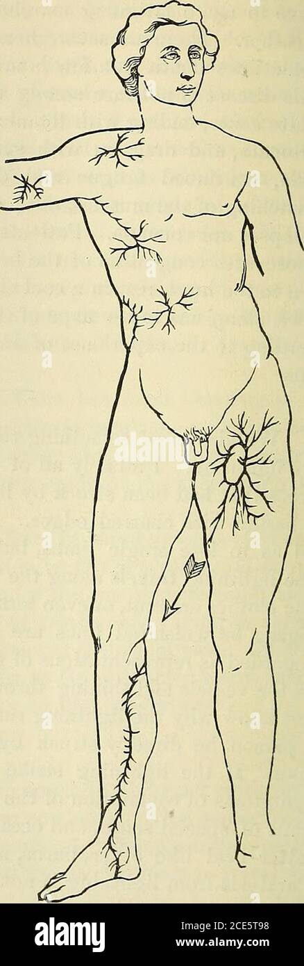 . Allgemeine chirurgische Pathologie und Therapeutik, in einundfünfzig Vorlesungen .. . Blitzspuren (nach Strieker). Weiß, die Haut zerknittert, das Gefühl vermindert; nach einer Zeit vergehen die Symptome, die Haut wird rot, der Finger schwillt an, und es entsteht ein eigenartiger Juckreiz und Prickeln. Das erhöht sich je mehr, desto morequickly Wärme folgt der Kälte. Die Rötung der Haut dieses Frostbeißgrades unterscheidet sich von der bei Verbrennungen durch ihre bläuliche Veilchenfarbe. Nach einer Zeit klingen diese Symptome ab und die Haut wird wieder zu FROSTSTICHEN. 273 Normal. In der Regel werden keine Mittel in diesen Sligh verwendet Stockfoto