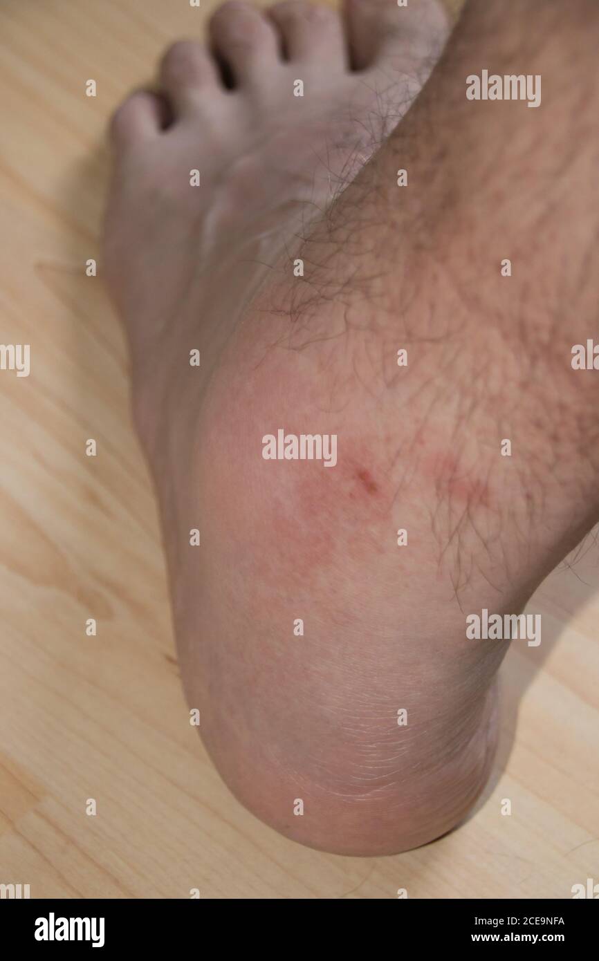Der Knöchel eines Mannes ist stark geschwollen, nachdem er gebissen wurde Bei einer Wespe Stockfoto