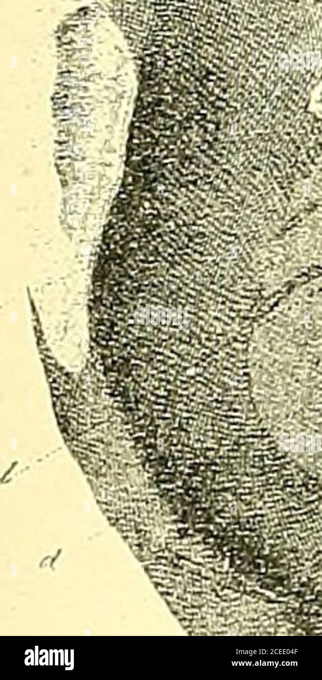 . Die Anatomie und chirurgische Behandlung von Hernie. Aused Tod. Es produzierte keine sichtbare äußere Schwellung. Der Tumor war übergroß eines kleinen Hühnereis und enthielt einen sphacelierten Darm und ein Omentum. Es wurde von dem Pektineus und Adductor longus bedeckt, und ruhte auf den Gefäßen und Nerven. In der sehr großen Anzahl von Sektionen, die Cloquet für das Ziel der Hernie gemacht hat, untersuchte er natürlich den Thyreidealkanal und gab ihm als Opin-Ion, dass diese Hernie-Vielfalt viel häufiger war, als allgemein angenommen wird.bei postmortem Untersuchungen, wie gewöhnlich durchgeführt, bin ich mir sicher, dass die Peri Stockfoto