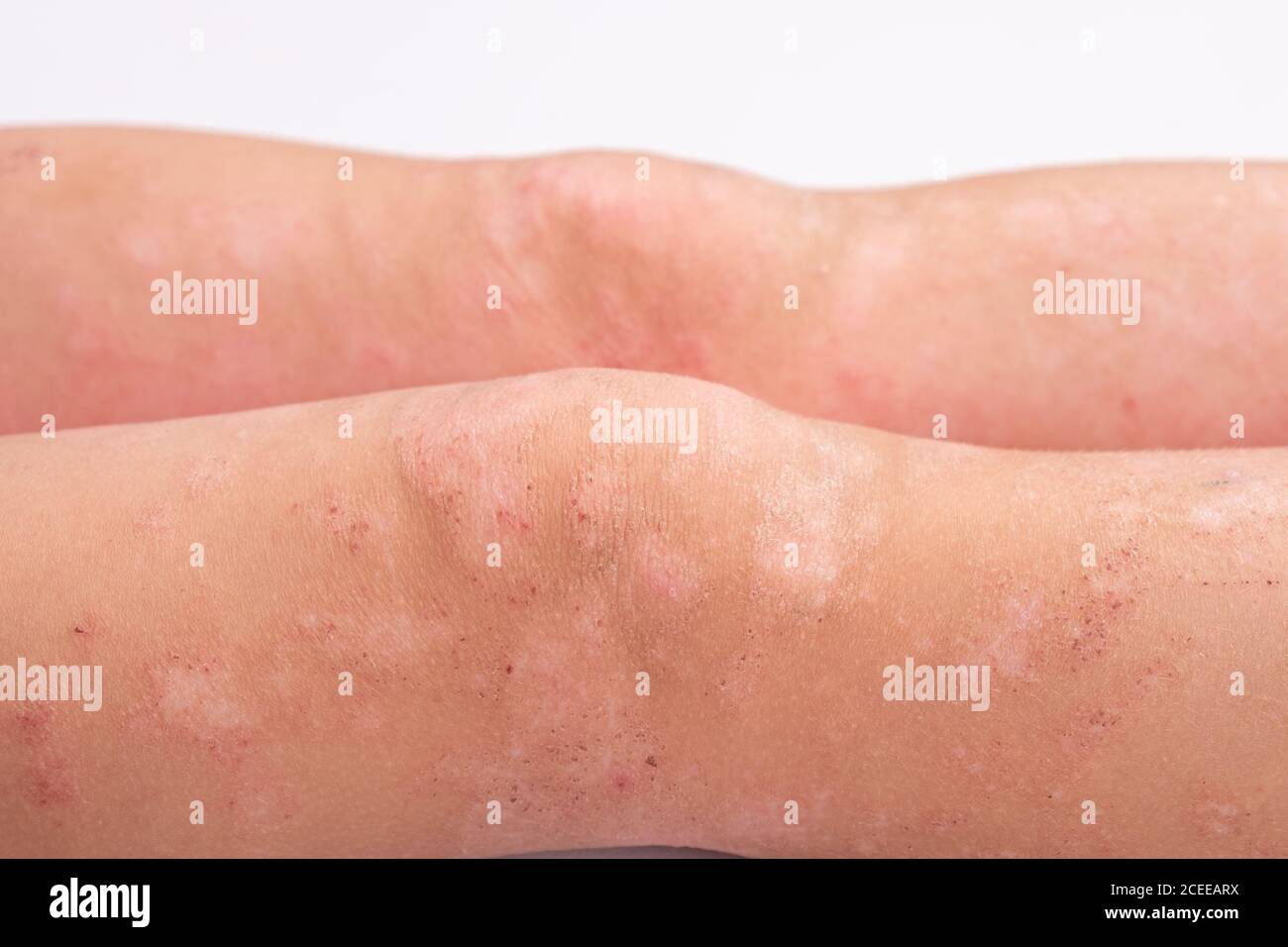 Manifestation von Dermatitis am Körper des Kindes, Hautausschlag an den Beinen Nahaufnahme