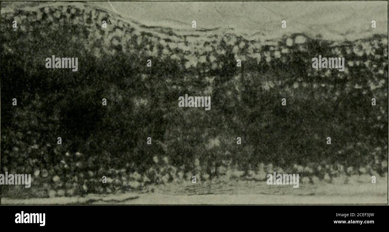 . Pathogene Mikroorganismen, einschließlich Bakterien und Protozoen; ein praktisches Handbuch für Studenten, Ärzte und Gesundheitsbeauftragte. Aspergillus fumigatus. Gelatinekultur. Mit Enzian-violett befleckt verteilen. 500 : 1 (von Itzerott und Niemann.) Sporen, die unregelmäßig erscheinen, stapeln sich wie Zoogloeamassen; und, wachsend außen, bilden sie eine dichte Scheide um das Haar. Die Sporen von T.megalosporon sind immer in verschiedenen Myzel-Filamenten enthalten, die entweder resistent sein können, wenn das Haar aufgebrochen oder zerbrechlich und Abb. 157. Haare mit Ringwurm-Pilz durchsetzt. Megalo.sporon Sorte. Leicht zu brechen Stockfoto