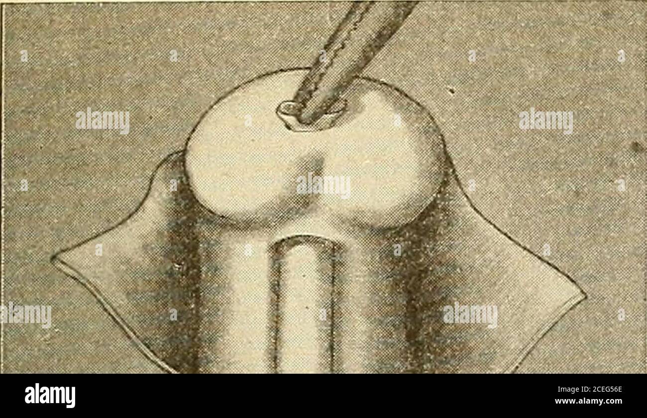 . Ein neues Handbuch der Chirurgie, zivile und militärische. E-Kanal an dieser Stelle. Diese Operation lässt den Patienten in einem sehr komfortablen Zustand zurück, aber zum Glück kommen diese Betroffenen nicht so sehr in die Obhut des Chirurgen, dass das Verfahren in der Regel gerechtfertigt ist. Sofern der Fall nicht abso-lut beginnend ist, raten wir nie zu dieser Operation, da sie fast immer durch Rezidivrezidive ausgehöhlt wird, und leider in den wiederkehrenden Fällen ist die Krankheit oft so weit fortgeschritten, dass eine vollständige Exzision nicht mehr möglich ist, während, wenn die unten beschriebene umfangreiche Operation ziemlich früh durchgeführt wird, die rel Stockfoto