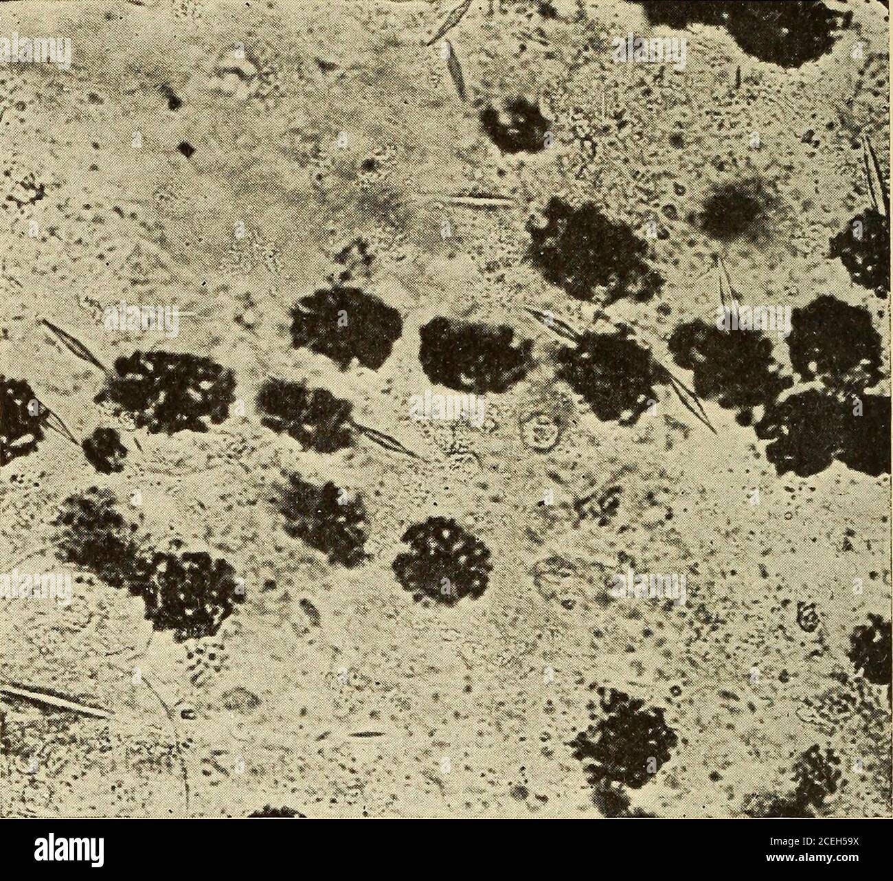 . Pathologische Technik; ein praktisches Handbuch für Arbeiter in der pathologischen Histologie und Bakteriologie. Blaue Lösung für einige Sekunden auf dem Deckglas. Die Preparation wird dann in Wasser gewaschen, mit Alkohol gespült, mit Xylol gereinigt und in Balsam montiert. Von den tierischen Parasiten wird die entamoeba histolytica einige Male nach einem Leberabszess gefunden, der in die Lunge perfo-bewertet ist (siehe Seite 381). Teile des Membranes einer Echinococcus-Zyste oder der Hakenschnabelchen aus dem Kopf können im Sputum gefunden werden, aber Infektion mit diesem Parasiten ist veryrare in diesem Land. Der Kristalle Stockfoto
