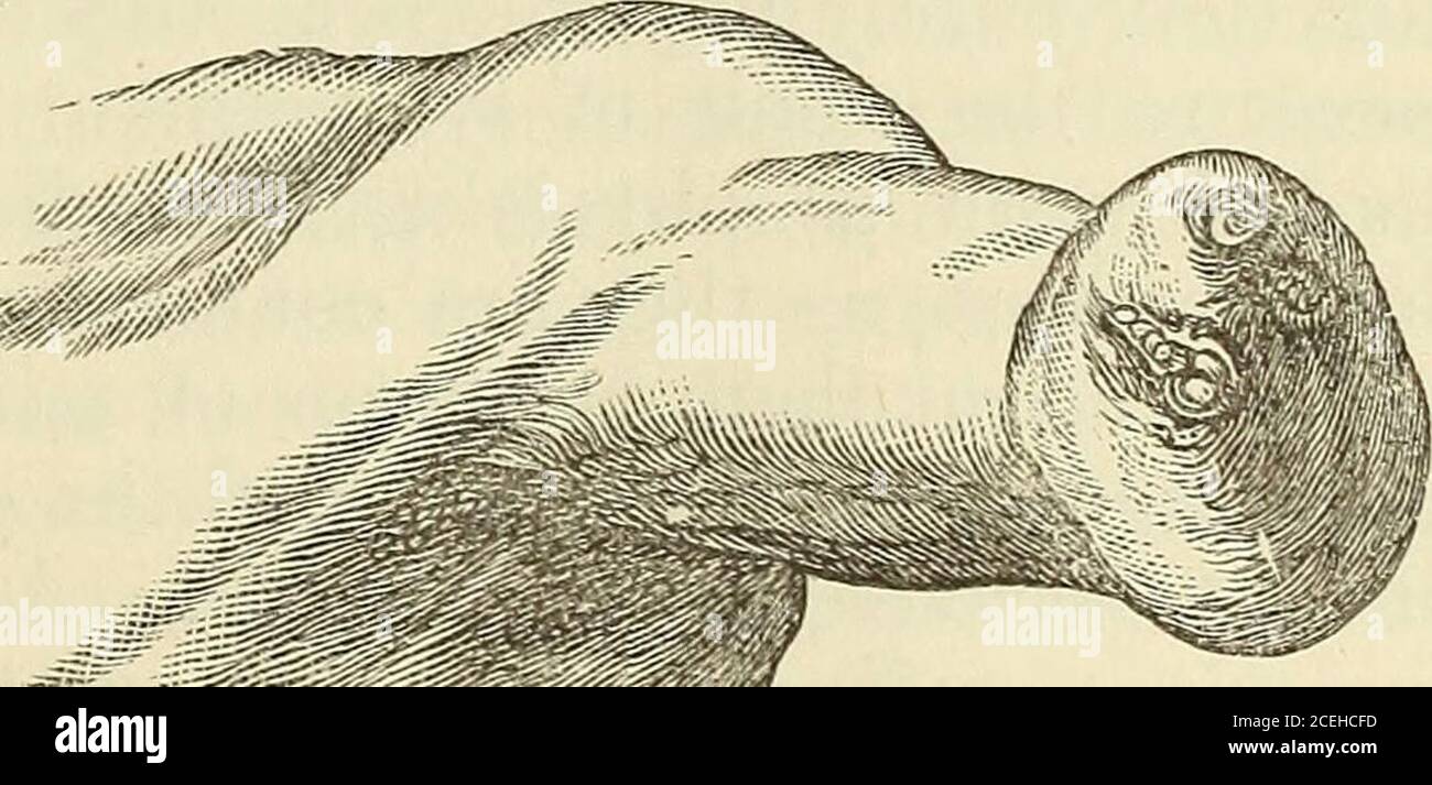 . Ein System der Hebamme, einschließlich der Krankheiten der Schwangerschaft und des puerperalen Zustandes. Iished mit minutennails. Zur Veranschaulichung ist die angehängte Gravur angegeben, die den Stumpf des linken Unterarms eines Fötus des siebten Monats wiedergibt, der im Geburtshilfe-Mu-seum der Universität Ed in- Abb. 94.burgh. Es gibt fünf kleine rudimentäre Finger mit winzigen Nägeln, in der üblichen Position auf dem Ende des Baumes gekippt. Abweichungen vom ordinaryprocess der Entwicklung führen quently zu Resultationen, die Monstrositäten bilden.das Subjekt von Monstern, wie- * / überhaupt, obwohl Stockfoto