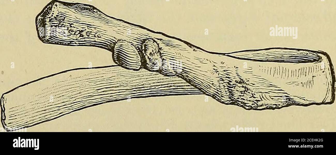 . Quain's Elemente der Anatomie. Wahr, und die restlichen fünf Paare asternal oder falsche Rippen. Ofhese asternal Rippen, jeder der oberen drei hat seinen Knorpel entlang seiner oberen Grenze zu dem Knorpel der Rippe über ihm befestigt, während die beiden letzten sind völlig frei von solchen Befestigung, und sind daher c-dWad schwimmende Rippen. 26 THORAX. Allgemeine Zeichen der Rippen. - Diese sind am besten in den Rippen in der Nähe der Geige der Serie markiert. Die hintere Extremität ist rickened und wird als Kopf TUBEROSITYNON-ARTICULAR PAR ARTICULAR FACE SUBCOSTALES CROOVE- oder capitulum bezeichnet; es stellt ein Superior und ein i dar Stockfoto
