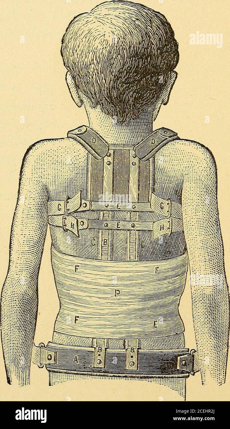 . Pott-Krankheit : seine Pathologie und mechanische Behandlung, mit Bemerkungen über Rotary lateral Krümmung. Krankheit, die in dieser Region erfordert die minimale Menge der Beobachtung, und die größte Anzahl von Fällen berichtet, von vielen Autoren, als geheilt, werden aus dieser Region ausgewählt. In Fällen, die die mittlere Region (die Superior dorsal) wefind viele Schwierigkeiten präsentieren in der Art und Weise der Sicherung eines ade-quate Grad der Fixation. Die Indikationen sind die Unterstützung der arigiden Projektion in der Mitte einer ansonsten flexiblen Säule.Darüber hinaus müssen wir mit dem konstanten Trau-matismus zu kämpfen haben, der res Stockfoto