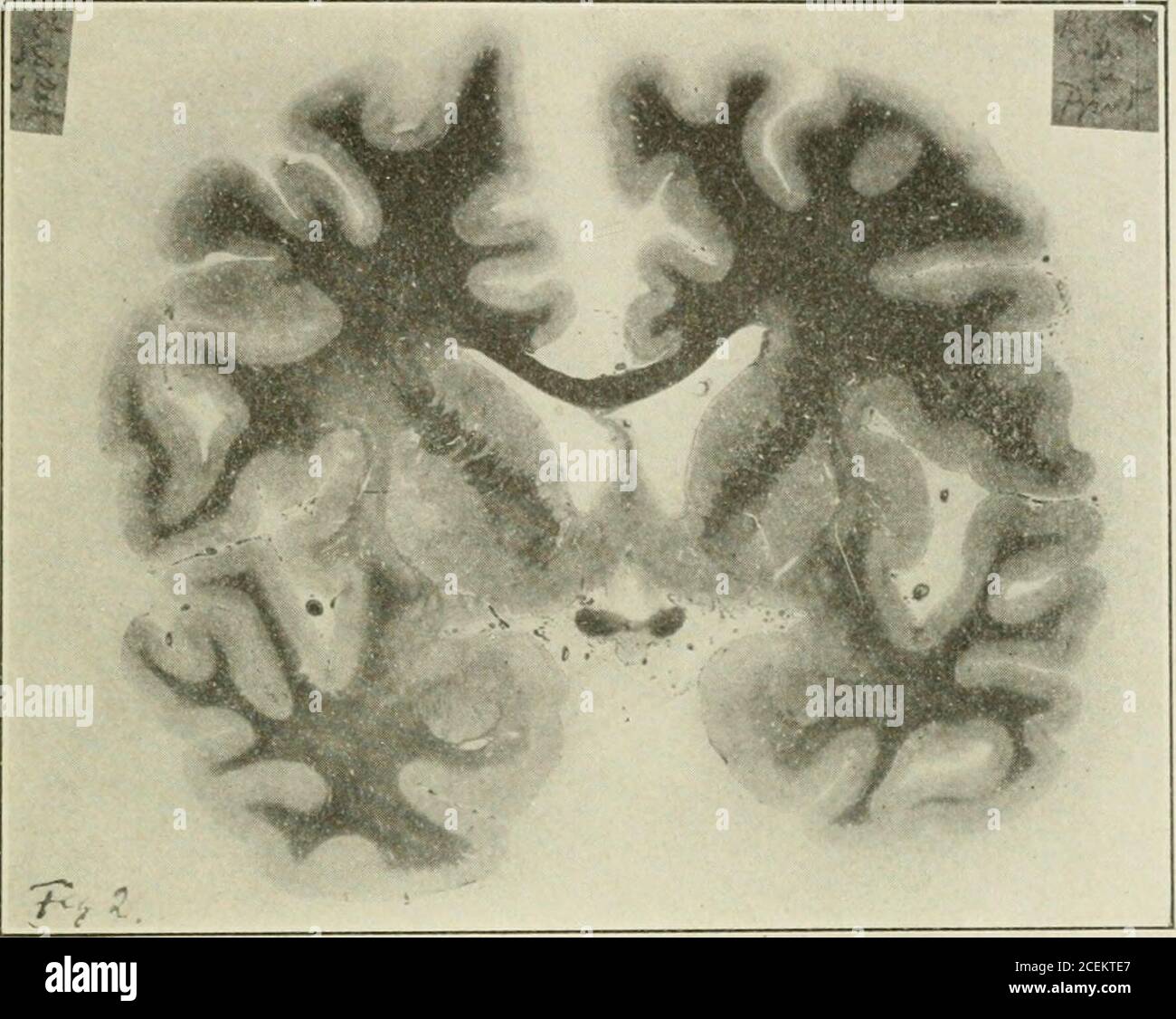 . Das Journal of Nervous and Mental Disease. ERVES. rht-Putamen leicht bemerkenswerte Veränderungen in der Leber bei Erkrankungen des Lentikularnukleus sollte betont werden, vielleicht, dass keine andere Zuneigung in der Leber gefunden wurde als die Foki der Lymphozyten. Die pia mater konnte ohne Schwierigkeiten aus dem Gehirn entfernt werden.ictionthrough the Brain in the coronal plane, passing through the lenticular nuclei, enhüllte einen deutlichen Unterschied in der Größe zwischen ihnen, das Recht schien viel geschrumpft. Große Gewebeblöcke wurden in Bichromat von Kaliumforral Monaten gehalten; diese ne Stockfoto