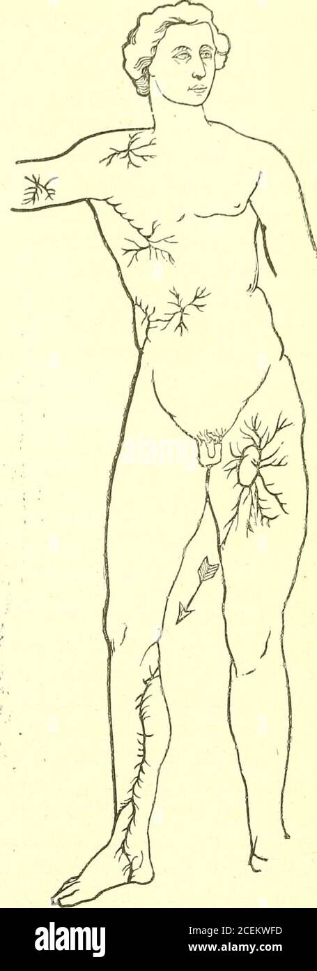 . Allgemeine chirurgische Pathologie und Therapeutik, in fünfzig Vorlesungen : ein Lehrbuch für Studenten und Ärzte. Blitzspuren (nach Strieker). Weiß, die Haut faltig, das Gefühl vermindert; nach einer Zeit vergehen die Symptome, die Haut wird rot, der Finger schwillt an, und es entsteht ein eigenartiger Juckreiz und Prickeln. Das erhöht sich je mehr, desto morequickly Wärme folgt der Kälte. Die Rötung der Haut dieses Frostbeißgrades unterscheidet sich von der bei Verbrennungen durch ihre bläuliche Veilchenfarbe. Nach einer Zeit klingen diese Symptome ab und die Haut wird wieder 262 VERBRENNUNGEN UND FROSTBISSE. Normal. G Stockfoto