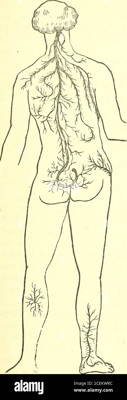 . Allgemeine chirurgische Pathologie und Therapeutik, in fünfzig Vorlesungen : ein Lehrbuch für Studenten und Ärzte. Wir wissen nicht, warum der Blitz läuft dieser eigentümliche Kurs auf der Haut. IFA Person direkt von Blitz getroffen werden, wird er in der Regel auf dem Topf getötet. Wenn der Blitz in seiner unmittelbaren Umgebung einschlägt, induziert es Tumtome des Gehirns, Lähmung bestimmter Gliedmaßen oder oder-gans von besonderem Sinn, und gelegentliche Extravasationen und Verbrennungen. Thelatter heilen wie andere Verbrennungen, je nach ihrem Grad und Ausmaß.Lähmung durch Blitzschlag ist in der Regel nicht von schlechter Prognose; die nervösund muskulös Stockfoto