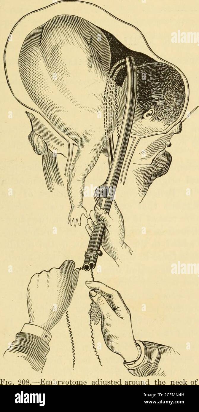 . Die Wissenschaft und Kunst der Hebamme. Des Betreibers. Dr.Kidd empfiehlt, eine Schnur an einem elastischen Ca-theter mit einem festen Stilett zu befestigen; dann, nachdem dem Instrument die richtige Kurve gegeben wurde, sollte sie um den Kinderhals geführt werden, und, da sie mit-gezeichnet ist, sollte die Schnur verwendet werden, um eine starke Schnur die Kette ecrasore in ihren Platz zu ziehen. Noch genialer ist das Embryotom von PierreThomas, bestehend aus zwei nach dem Vorbild eines von M. Tar-nier entwickelten teuren Instruments. Die gebogene Blaswand sollte dem Kreuzbein gegenüber liegen. Die gerade Klinge sollte einführen Stockfoto