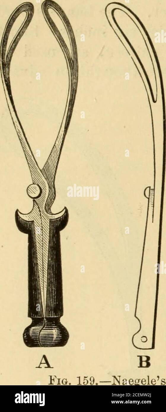 . Die Wissenschaft und Kunst der Hebamme. Um sie an die Handflächen anzupassen.die Artikulation erfolgte mittels eines Drehzapfens und einer Einsteckung.die Haupteigenheiten bestanden jedoch in dem Gewicht und der Länge des Instruments und in der Ausdehnung der Beckenkurve. Soweit von diesen Eigenschaften provinganfechtbar, sie wurden subsubstantiell in modernen französischen Instrumenten beibehalten. Die Pinzetten von Smellie und Levret sind die beiden Typenformen, aus denen sich die große Anzahl der Modelle in Mode heute ableitet. Die Naegele-Pinzette, die in Deutschland umfangreich eingesetzt wird, ähnelt in ihren Hauptmerkmalen der Stockfoto