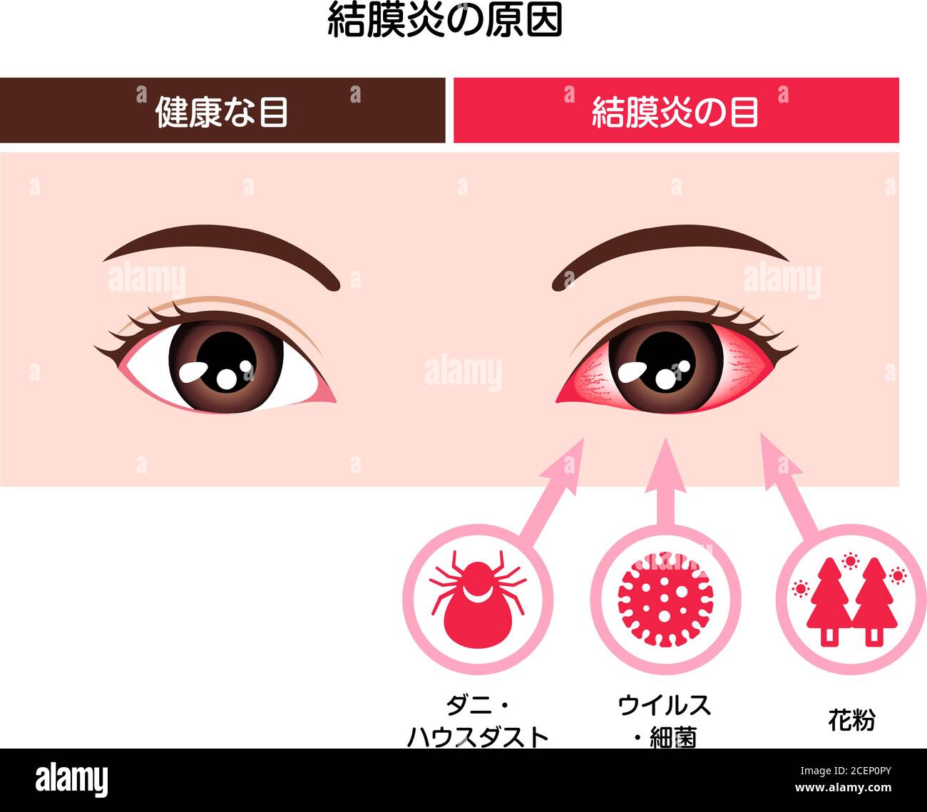 Ursachen der Konjunktivitis (rosa Auge) Vektordarstellung Stock Vektor