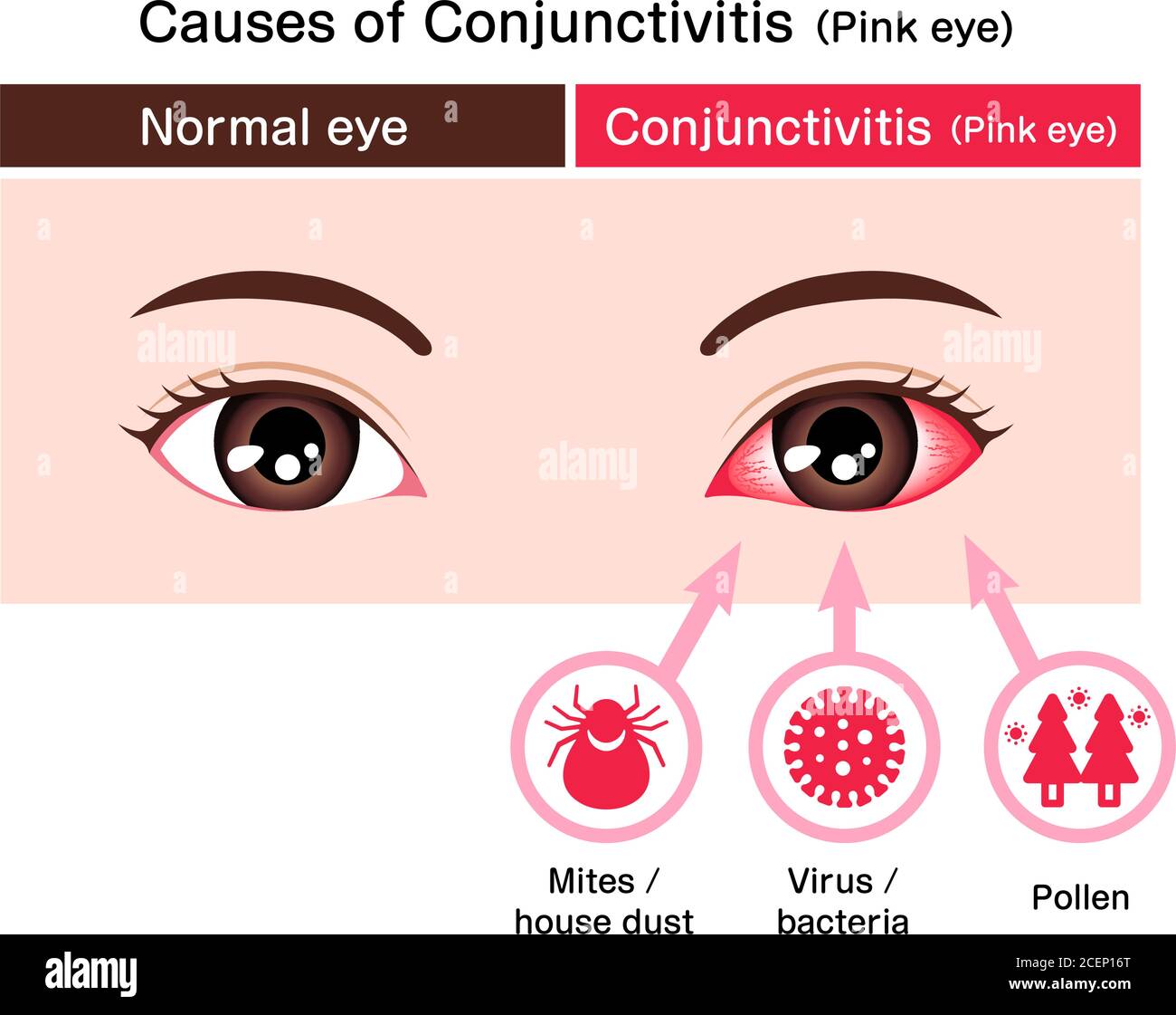 Konjunktivitis darstellung Fotos und Bildmaterial in hoher Auflösung