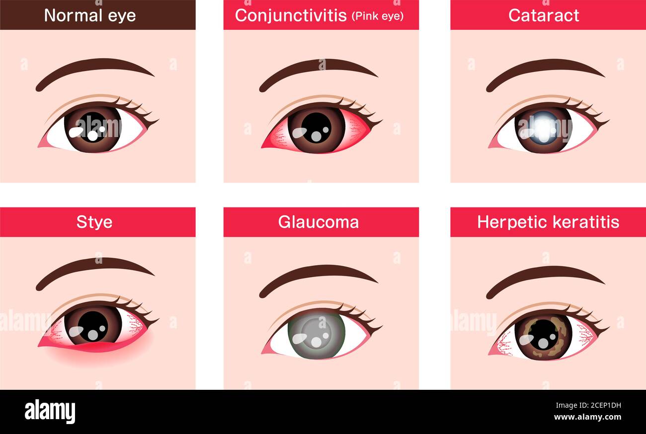 Verschiedene Augenerkrankungen Vektor-Illustration (weibliches Auge) Stock Vektor